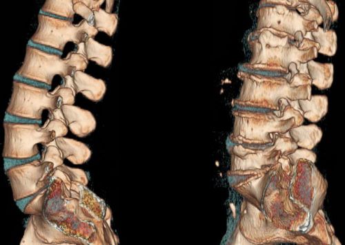 КТ-снимок позвоночника