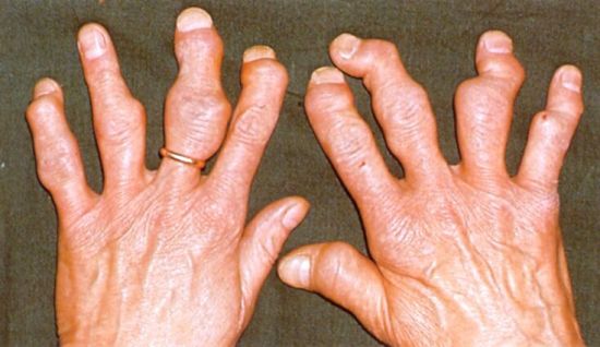 Пальцы рук при артрите