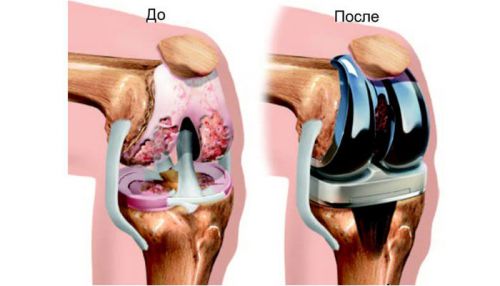 Артропластика колена