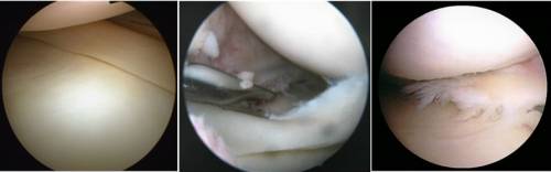 Артроскопические изображения коленного сустава