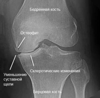 Рентгенография коленного сустава