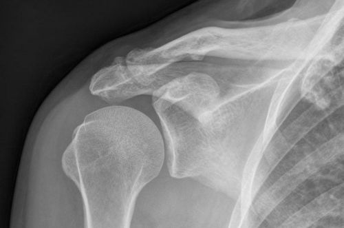 Рентген-снимок плеча