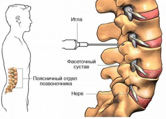 Укол в позвоночник