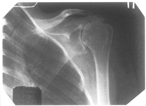 Рентген-снимок плеча