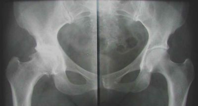 рентгенограмма тазобедренного сустава
