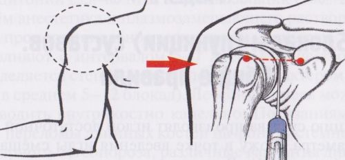 Блокада в плечо
