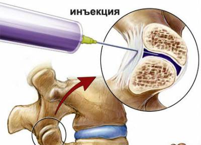 Место для блокады позвоночника