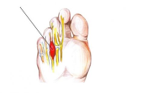 Неврома между пальцами