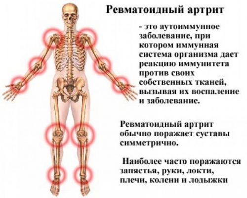 Ревматоидный артрит