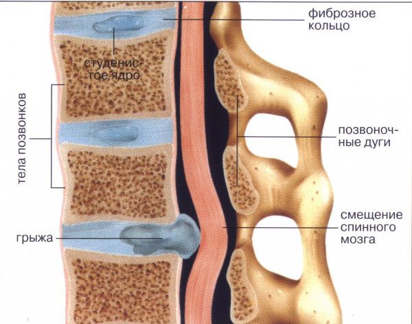 Грыжа позвоночника