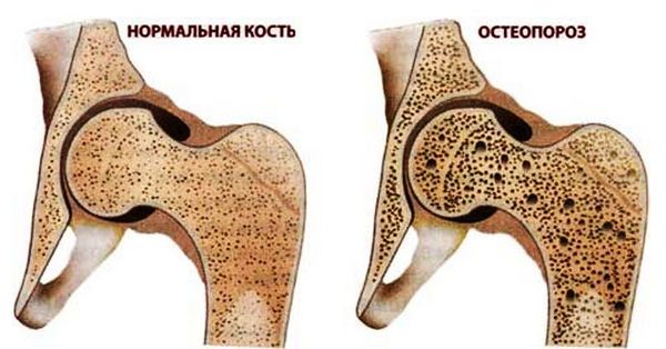 Остеопороз