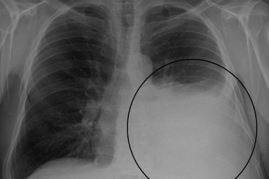 Пневмония на рентген-снимке