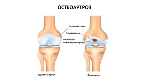 Остеоартроз сустава