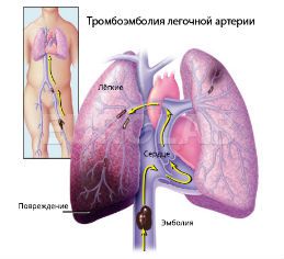 Тромбоэмболия легочной артерии