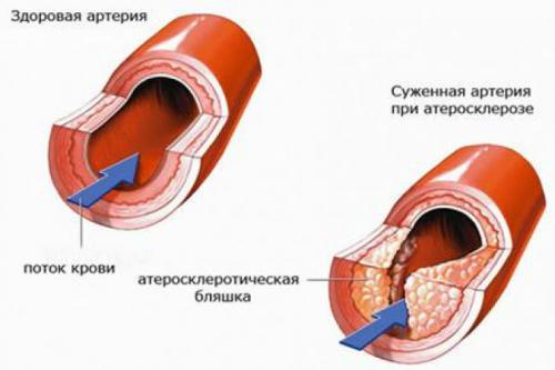Атеросклеротическое поражение артерий