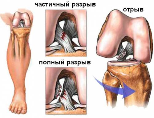 Повреждение связок коленного сустава