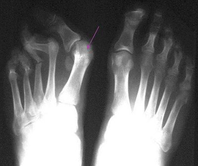 Рентген-снимок артрита пальцев