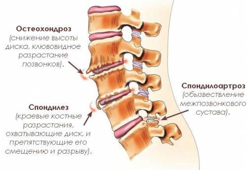 Дегенеративно-дистрофические заболевания позвоночника