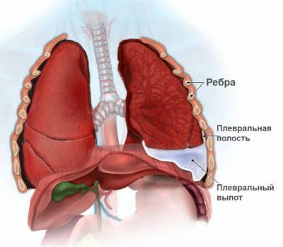 Плеврит