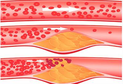 Атеросклероз артерий