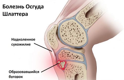 Бугорок возле большеберцовой кости