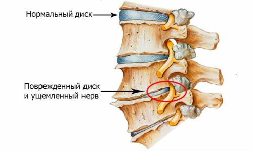 Остеохондроз позвоночника