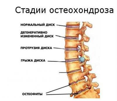 Дегенеративные изменения позвоночника