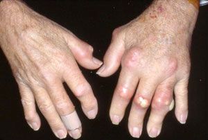 Подагрический артрит пальцев