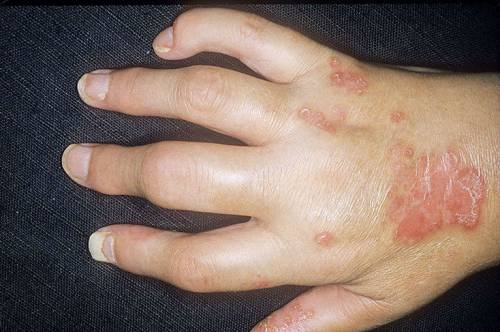 Псориатический артрит пальцев рук