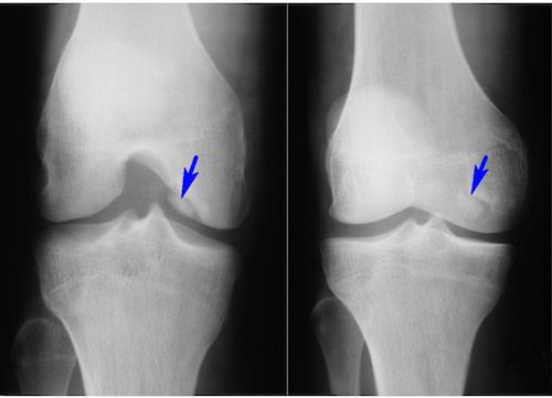 Рентгенография коленного сустава