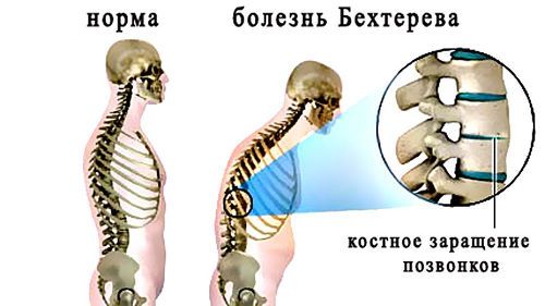 Скелет при болезни Бехтерева