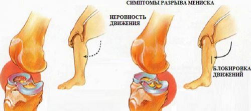 Симптомы разрыва мениска