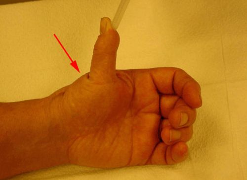 Деформация сустава на пальце
