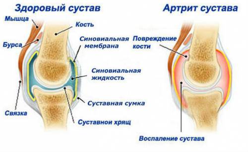 Артрит сустава