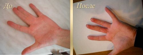 До и после операции на пальцах
