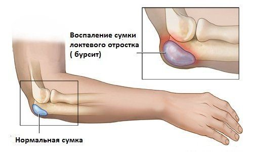 Локтевая синовиальная сумка