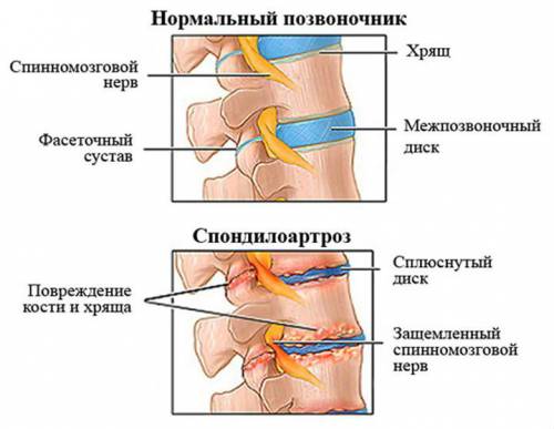 Спондилоартроз позвоночника