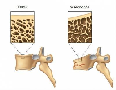Структура нормальной кости и при остеопорозе