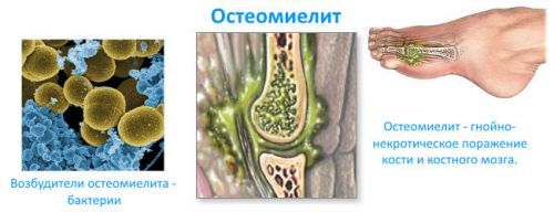 Схема развития остеомиелита