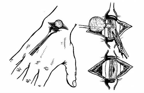 Схема удаления гигромы руки