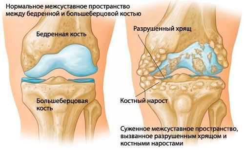 артроз коленного сустава