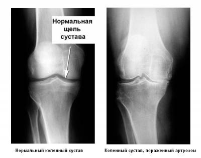 Рентгенография коленных суставов
