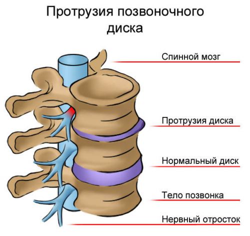 Протрузия позвоночного диска