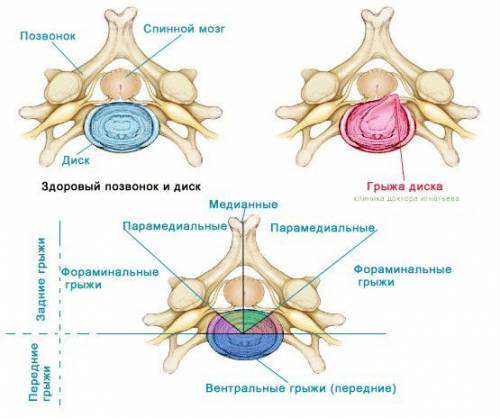 Виды межпозвонковых грыж