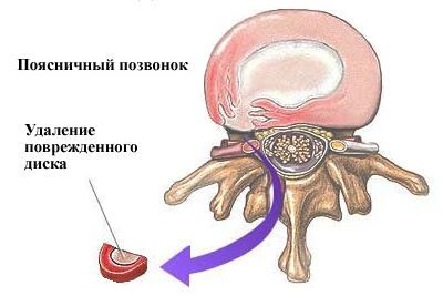 Операция дискэктомия