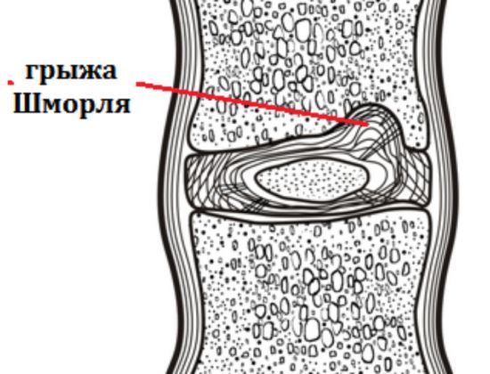 Грыжа Шморля