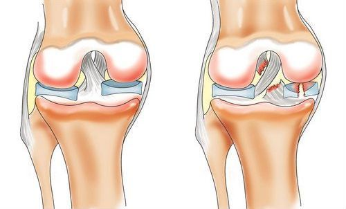 Разрыв связок в суставе
