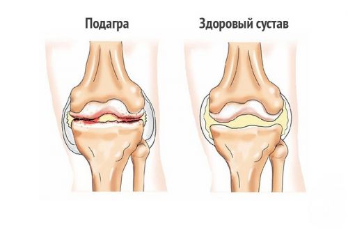 Сустав при подагре