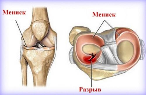 Разрыв мениска