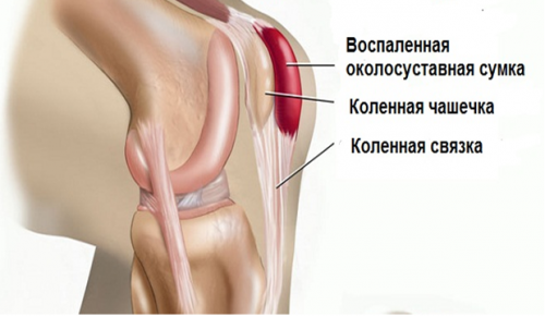 Бурсит колена